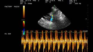 ESTENOSIS DE V PULMONAR Y DISPLASIA DE V TRICUSPIDE CON ESTENOSIS EN FELINO SEDICAR VET 61 [upl. by Euqinna516]