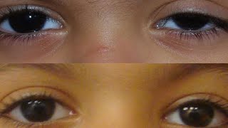 how to get rid of a lazy eyelid best exercises [upl. by Wes]