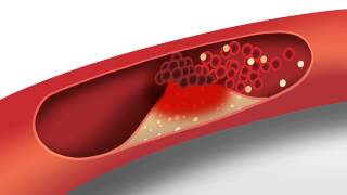 Cholesterol animation  Heart disease risk factors [upl. by Mandler677]