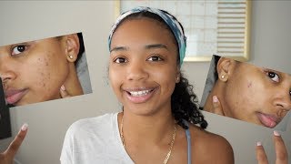 How I Got Rid of my Acne Marks  My Retin A Journey [upl. by Yrakaz]