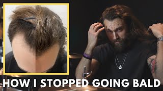 How I Got My Hair Back IN ONE YEAR  Male Pattern Baldness  Christopher Painter [upl. by Rhodie]