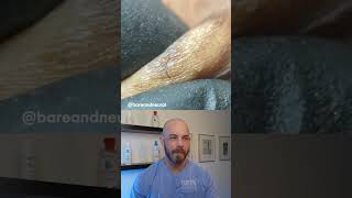 Ingrown hair frenzy ingrownhair dermreacts doctorreacts [upl. by Sherborne658]