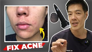 Getting Rid of Acne Scars at Home  Microneedling  Dr Davin Lim [upl. by Wally]