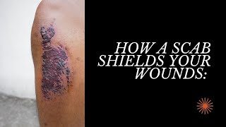 How a Scab Shields Your Wounds [upl. by Lowe128]