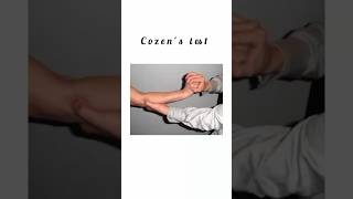 Cozens test kattrucate medicalreels diagnose tenniselbow pressure pain patient shorts [upl. by Nabatse]