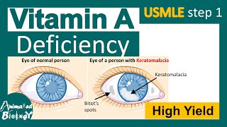 Vitamin A deficiency  xerophthalmia  Keratomalacia  nyctalopia  Phrynoderma  USMLE step1 [upl. by Treve]