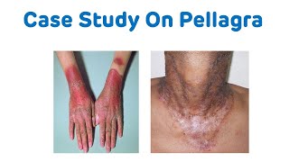 Case Study On Pellagra  Biochemistry Case Study  Pellagra B3 Deficiency [upl. by Allana]