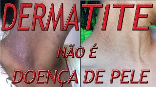 DERMATITE NÃO É UMA DOENÇA DE PELE  Entenda como se curar [upl. by Notserk]