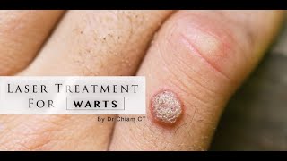 Warts removal with Laser Treatment  Dr Chiam CT [upl. by Darrej]