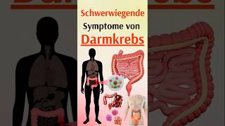 Schwerwiegende Symptome von Darmkrebs [upl. by Mikal]