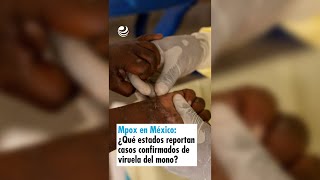 Mpox en México ¿Qué estados ya reportan casos confirmados de viruela del mono [upl. by Caralie]