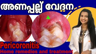 Pericoronitis  അണപ്പല്ല് വേദന  PericoronitisTreatment and home remedies in Malayalam  drshilpa [upl. by Tuesday]