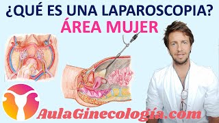 QUÉ ES UNA LAPAROSCOPIA PARA QUÉ SIRVE Y QUÉ VENTAJAS TIENE  Ginecología y Obstetricia [upl. by Lorrac653]