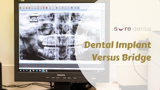 Dental Implant VS Dental Bridge [upl. by Janiuszck54]