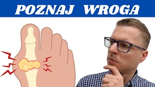 Dna Moczanowa  Podagra  Wszystko Co Musisz Wiedzieć Krótko i Na Temat [upl. by Arber]