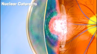 Do you know there are different types of cataracts Dandelion Medical Animation [upl. by Minta]