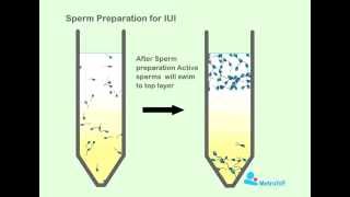 Sperm Preperation For IUI [upl. by Elatsyrc743]