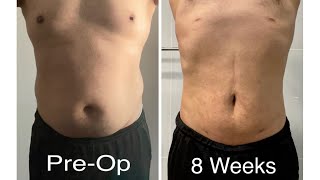 Liposuction PostOp 8 weeks update SONOBELLO [upl. by Ylime]