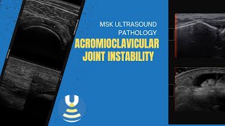 Acromioclavicular joint instability seen on diagnostic ultrasound [upl. by Orion]