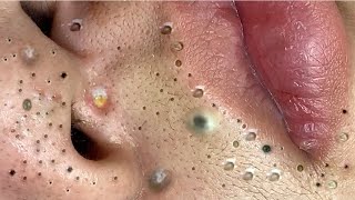 Big Cystic Acne Blackheads Extraction Blackheads amp Milia Whiteheads Removal Pimple Popping  1424 [upl. by Fagaly]