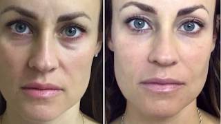 Dermal Filler Under Eyes Tear Trough [upl. by Leicam]