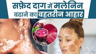 मेलानिन की कमी दूर करने लिए क्या खाएं  Melanin Increase Food Bharat Homeopathy Vitiligo Treatment [upl. by Vershen]