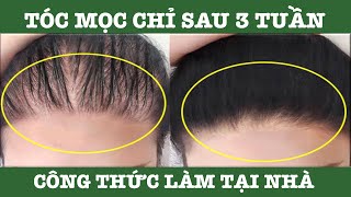 Chữa và chống rụng tócđiều trị chứng hói đầu [upl. by Eelarbed]