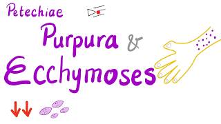 Petechiae Purpura and Ecchymoses [upl. by Nelg218]