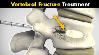 How Vertebral Compression Fracture Is Treated  Vertebroplasty And Kyphoplasty UrduHindi [upl. by Lletnahc643]