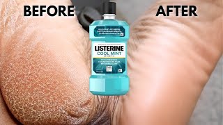 TRY LISTERINE ON YOUR DRY CRACKED FEET AND SEE WHAT HAPPENS SHOCKING RESULTS [upl. by Baun]