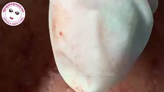 Acne facial removal treatment by Sopheaskincarecambodia [upl. by Mair]