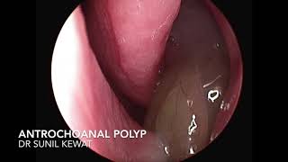 Antro Choanal Polyp  Nasal Endoscopy [upl. by Tarah]