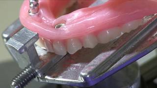 Eliminating Attachment Binding in Implant Overdentures [upl. by Pryor71]