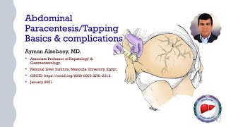 Abdominal ParacentesisT apping Basics amp complications [upl. by Sulokcin258]