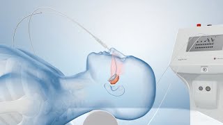 Cancer Treatment with Brachytherapy Medical Animation [upl. by Anitselec]