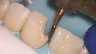 Teeth Bonding  Front tooth filling EXPLAINED [upl. by Ahsienor]