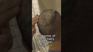 removing scabs after a hair transplant hairloss hairtransplant [upl. by Dabbs95]