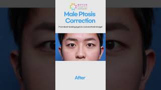 Getting Rid of Unnaturally Thick Double Eyelids  Male Ptosis Correction [upl. by Borchers543]