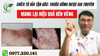 Chữa Tổ Đỉa Tận Gốc Thuốc Đông Dược Gia Truyền Mang Lại Hiệu Quả Bền Vững [upl. by Oakman]