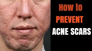 ACNE SCARS  how to prevent [upl. by Atiram880]