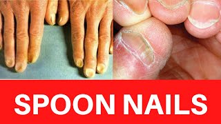 SPOON NAILS  Koilonychia Causes Treatment Symptoms Iron deficiency Anemia Cure Prevention [upl. by Yale]