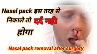 Nasal pack removal after septoplasty Nasal pack removal [upl. by Northey]