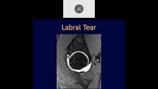 MRI of the Hip Part 7 – Hip Labrum [upl. by Hilliard]