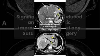 Liver Hemangioma Treatment Embolization Procedure Explained  Dr Amol Lahoti shortsfeed2024 [upl. by Aihseym]