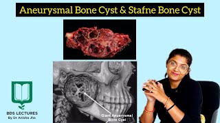 Aneurysmal Bone Cyst  Stafne Bone Cyst  Lecture 18  Oral Pathology [upl. by Armitage]