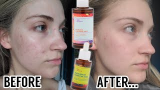 I Tried The Good Molecules Niacinamide Toner amp Discoloration Correcting Serum For 2 Months [upl. by Alikahs]