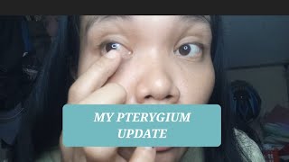 my Pterygium surgery update  beverlylayug [upl. by Pengelly]