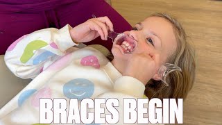 GETTING STARTED WITH BRACES AT AGE 8  SHORTEN BRACES TIME  MOUTH EXPANDER  TOO YOUNG FOR BRACES [upl. by Phillips]