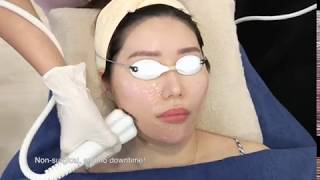 Diamond Polar Radiofrequency Treatment [upl. by Akinyt633]