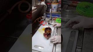 ovarian cyst cyst histopathology [upl. by Enaenaj]